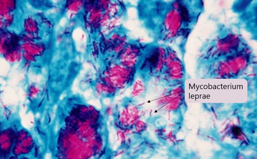 A dangerous parasite, a hidden tumour and leprosy….pathology in Tasmania
