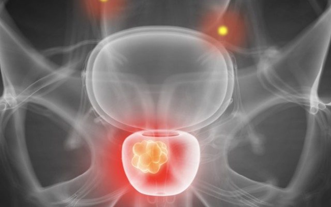 Prostate cancer medical imaging